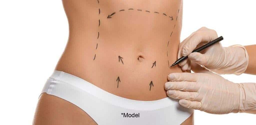 polish your perfect summer tummy with abdominoplasty 61bcddd9bf901 1024x640 1