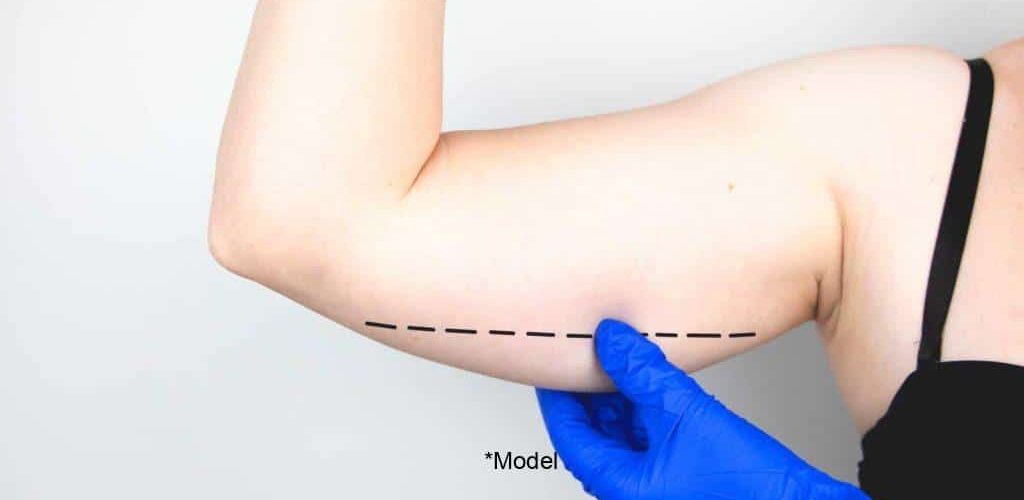 sculpt your arms in time for summer with brachioplasty 61bcddcbab737 1024x640 1