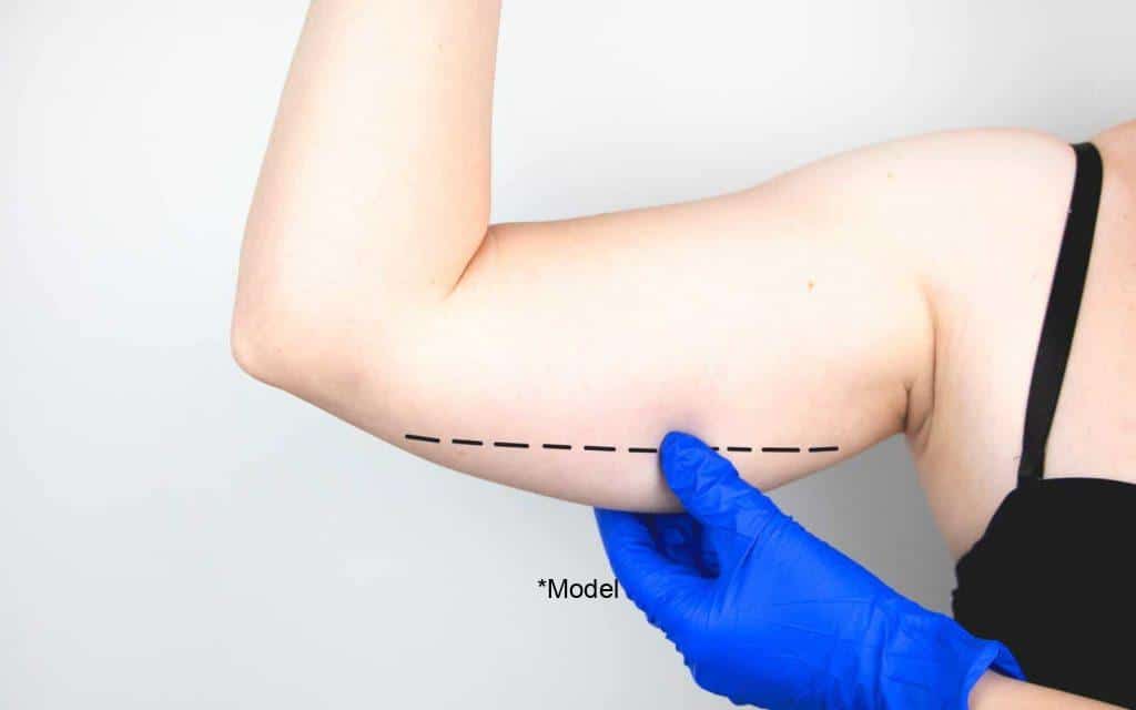 sculpt your arms in time for summer with brachioplasty 61bcddcbab737 1024x640 1