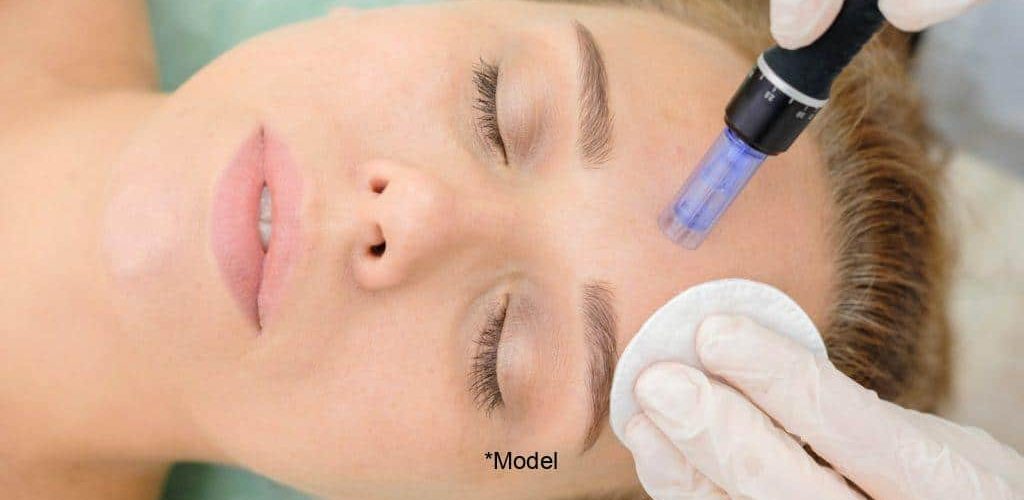 how microneedling can be a miracle for your skin 61bcddaf04bd2 1024x640 1