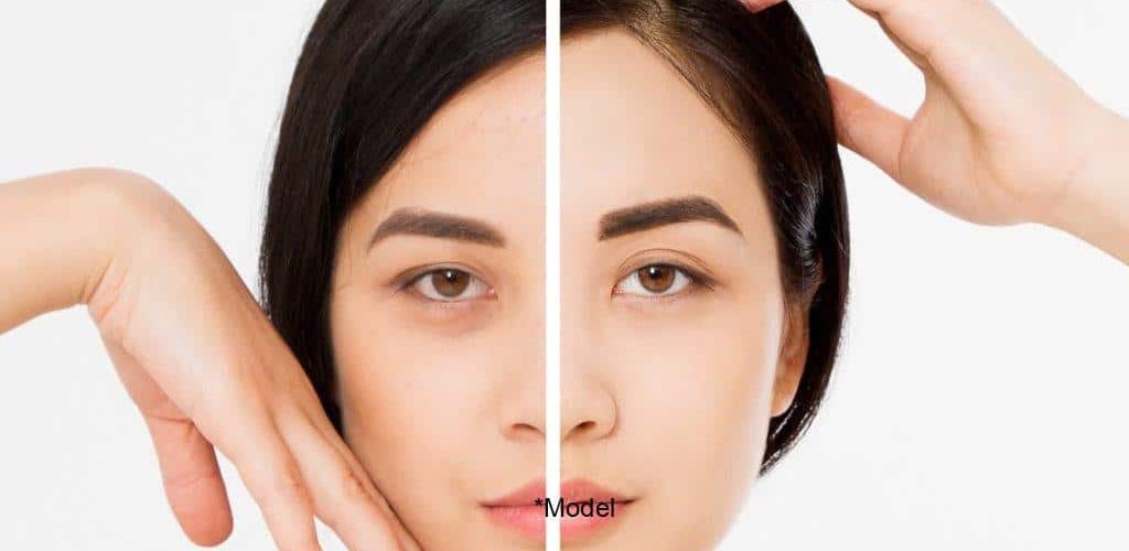 why women are diving into the world of brow lifts 61bcdda250e2d 1024x640 1