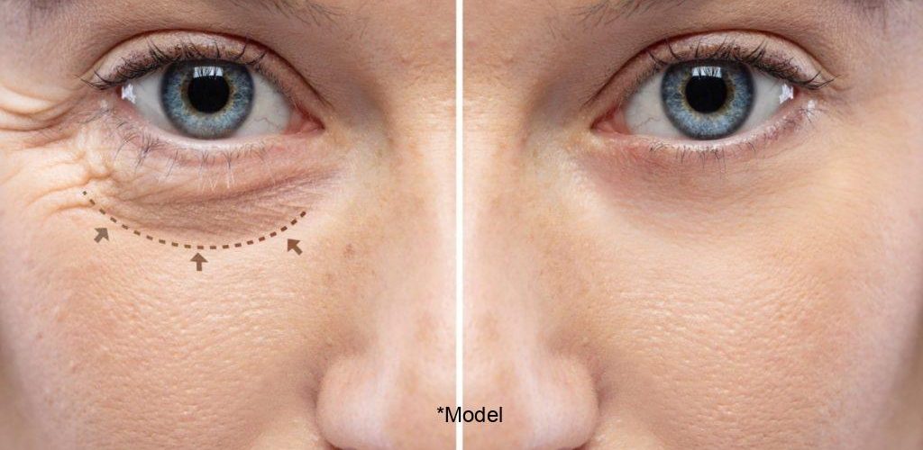 blepharoplasty and how it can take years from your eyes 61bcbe4f9f2b8 1024x640 1