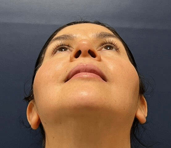 After Image: Rhinoplasty - front