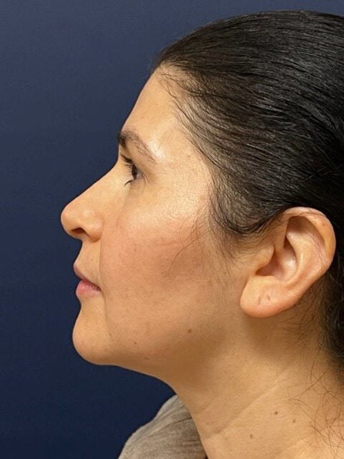 After Image: Rhinoplasty - left-side