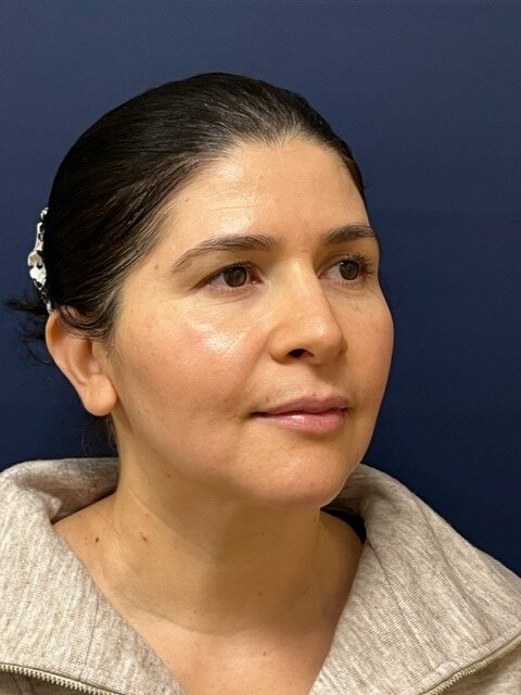 After Image: Rhinoplasty - right-front-oblique