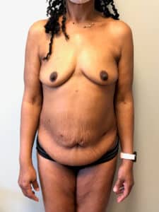 Tummy Tuck and Breast Augmentation