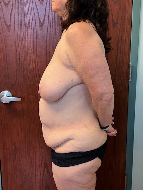 Before Image: Breast Reduction and Tummy Tuck - left-side