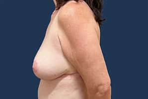 After Image: Breast Reduction - left-side