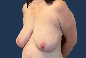 Before Image: Breast Reduction - 