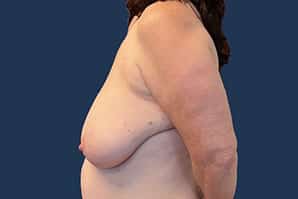 Before Image: Breast Reduction - left-side