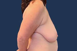 Before Image: Breast Reduction - right-side