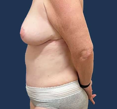 After Image: Tummy Tuck - left-side