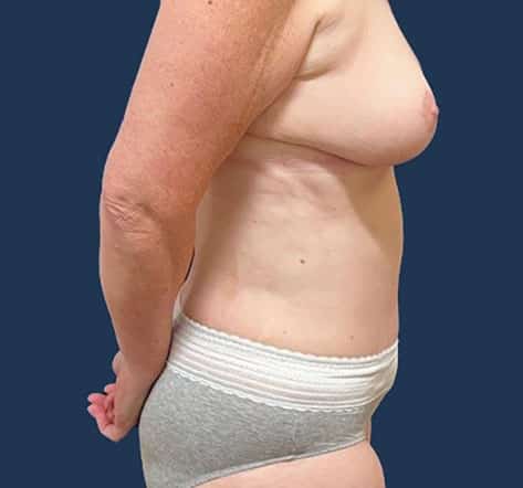 After Image: Tummy Tuck - right-side