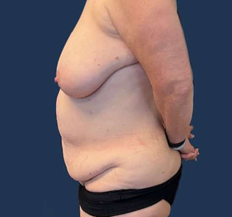 Before Image: Tummy Tuck - left-side