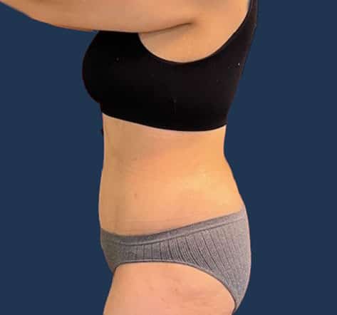 After Image: Tummy Tuck with Liposuction - left-side