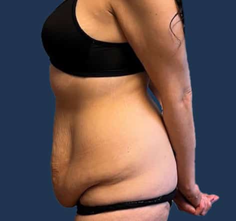 Before Image: Tummy Tuck with Liposuction - left-side