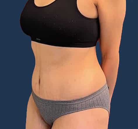 After Image: Tummy Tuck with Liposuction - left-front-oblique