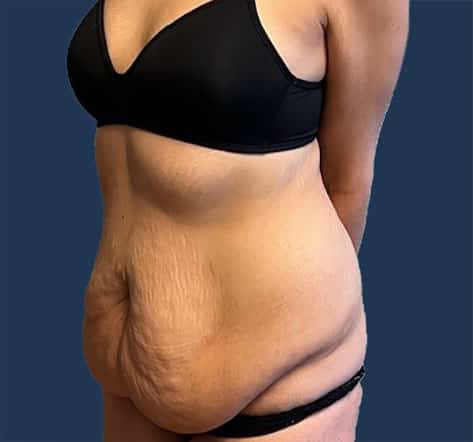 Before Image: Tummy Tuck with Liposuction - left-front-oblique