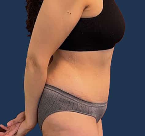 After Image: Tummy Tuck with Liposuction - right-side