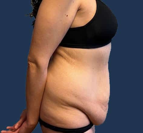 Before Image: Tummy Tuck with Liposuction - right-side