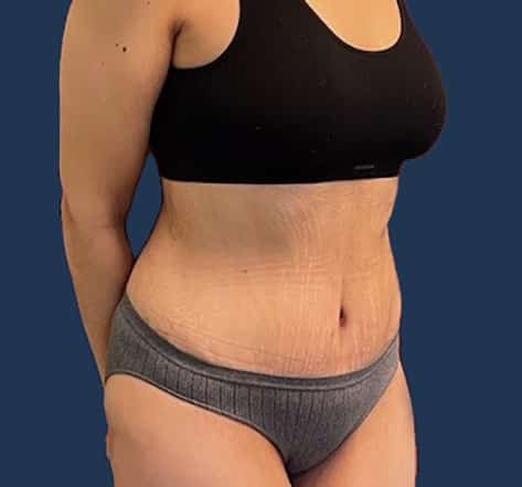 After Image: Tummy Tuck with Liposuction - right-front-oblique