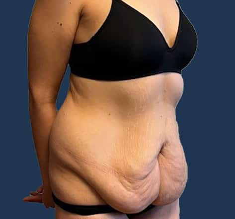 Before Image: Tummy Tuck with Liposuction - right-front-oblique