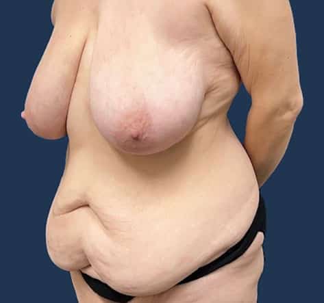 Before Image: Abdominoplasty - left-front-oblique