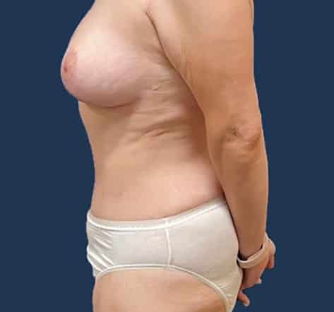 After Image: Abdominoplasty - left-side