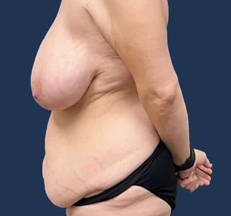 Before Image: Abdominoplasty - left-side