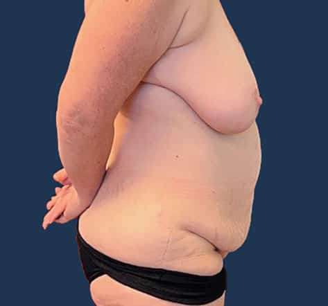 Before Image: Tummy Tuck - right-side