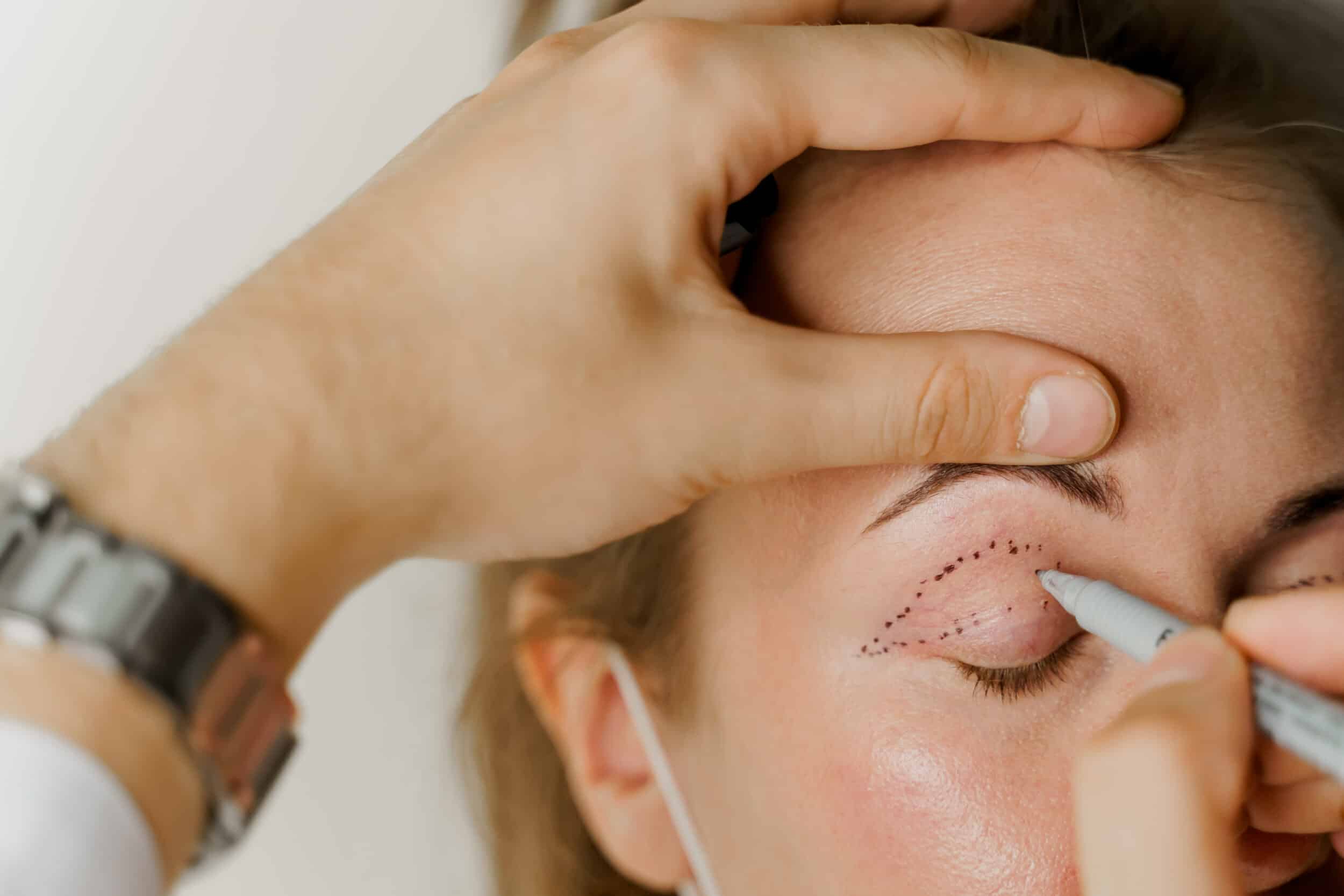 A doctor marking a woman’s eye for eyelid surgery