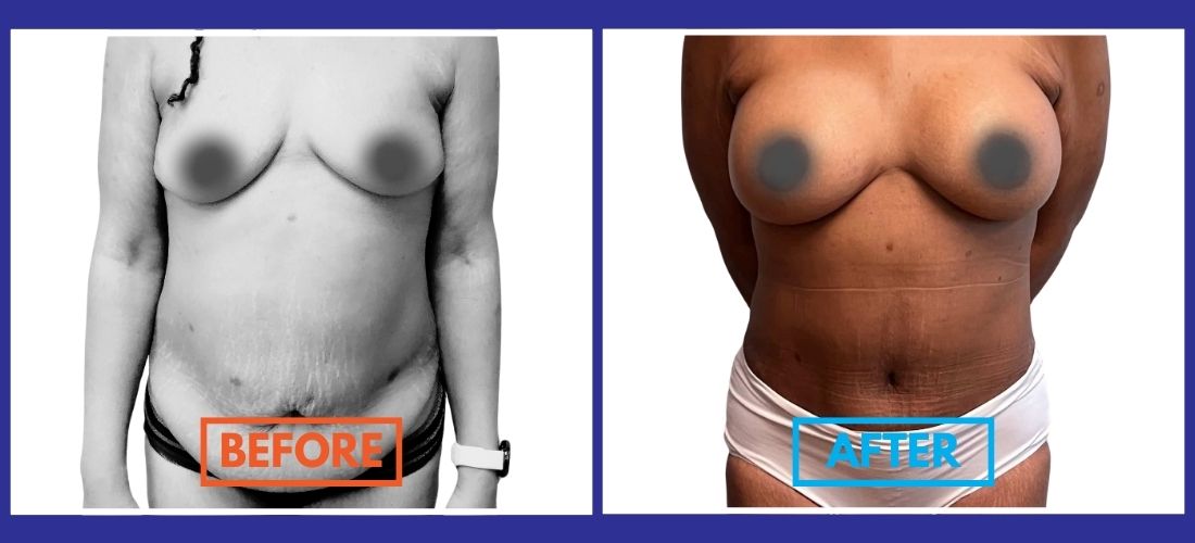 Side-by-side comparison showing a person before and after body transformation. Left: "Before" with visible abdominal area. Right: "After" with toned midsection. Both faces are obscured.