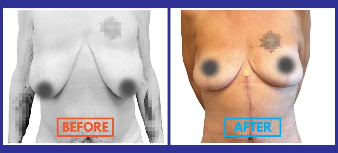 Split image showing the before & after of a breast lift: left side features sagging, while the right side reveals firm contours and a surgical scar. Both sides include pixelated areas for privacy.