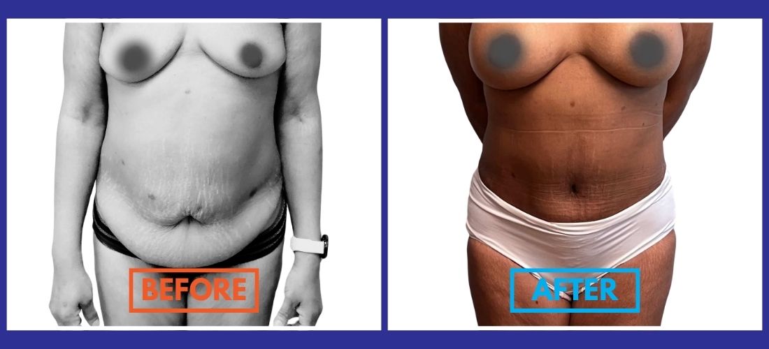 Split image of a person. Left side labeled "Before" shows loose abdominal skin; right side labeled "After" shows a toned abdomen. Both images show a person standing in underwear.