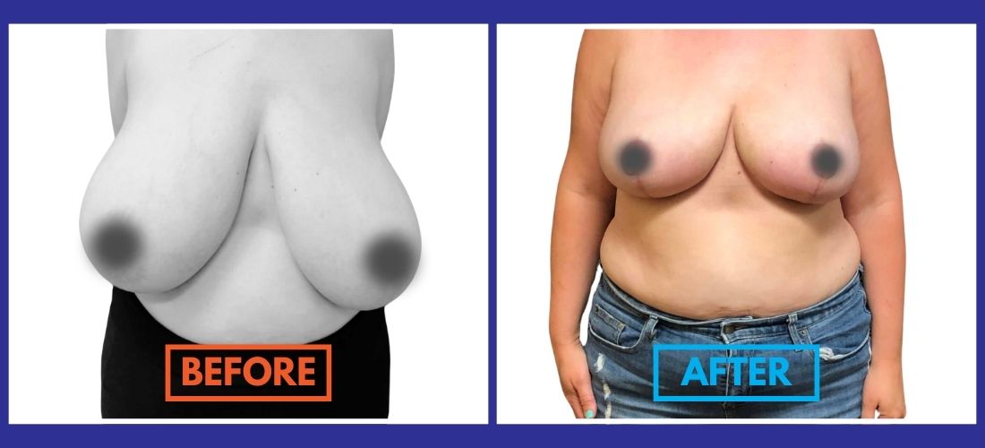 Side-by-side comparison of a torso before and after breast reduction surgery, with the before image in black and white and the after image in color. Text reads "BEFORE" and "AFTER.