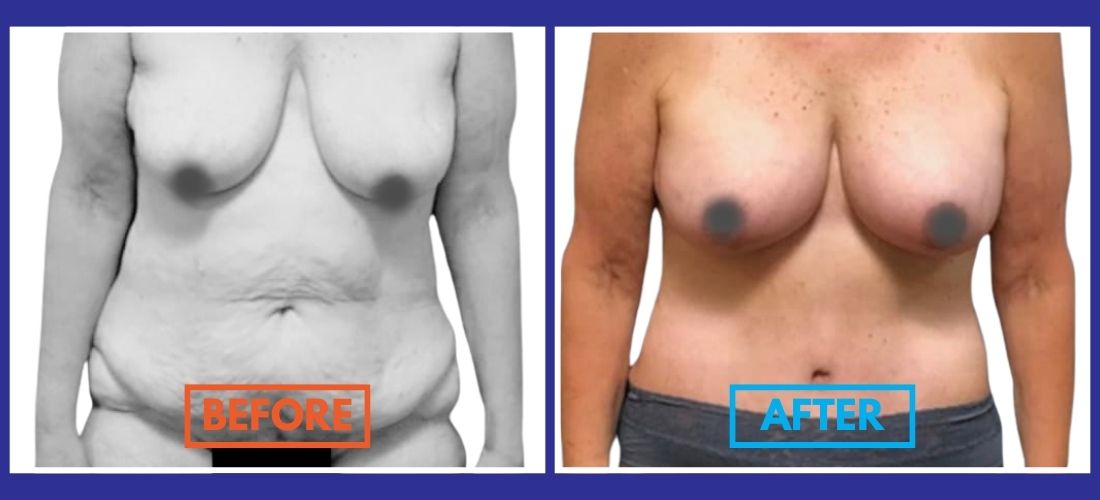 Before and after photo comparison of a torso showing changes in body contour and skin appearance. The left side is labeled "Before" and the right side is labeled "After.