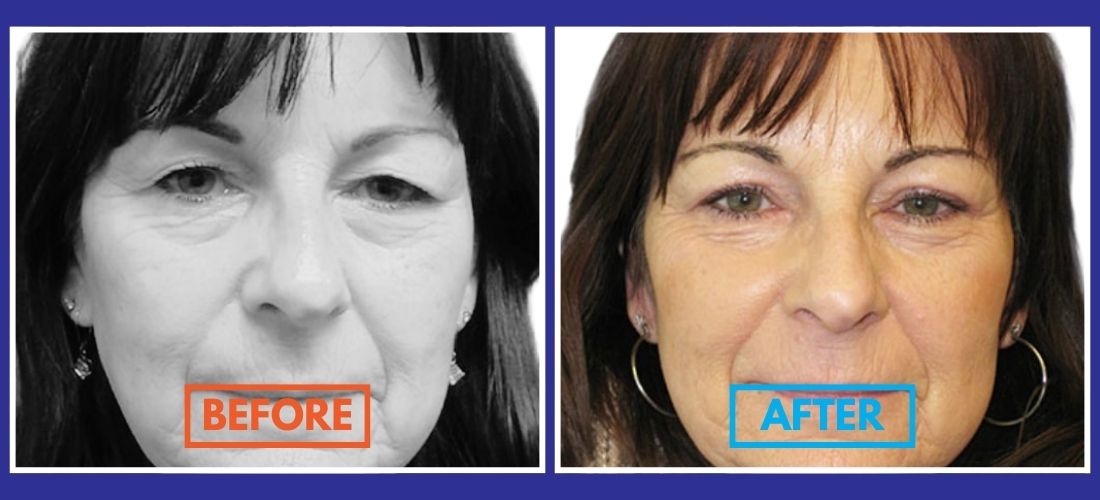 Side-by-side comparison of a woman's face labeled "Before" and "After," showing visible skin changes and reduced wrinkles in the "After" image.