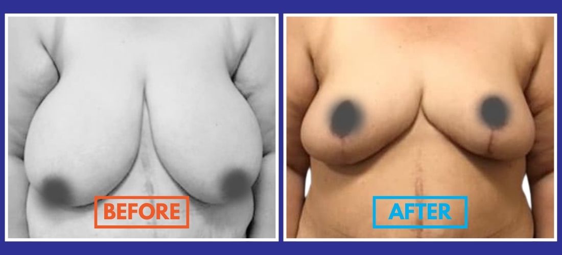 Side-by-side comparison showing a body before and after breast reduction surgery, with "Before" and "After" labels.