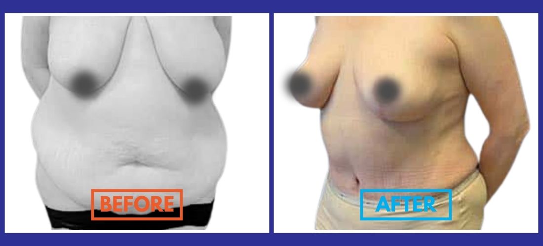 A side-by-side comparison highlights a dramatic body transformation. The left image shows a larger abdomen, while the right reveals a slimmer waist after a tummy tuck, with visible surgical scars marking the journey's success.