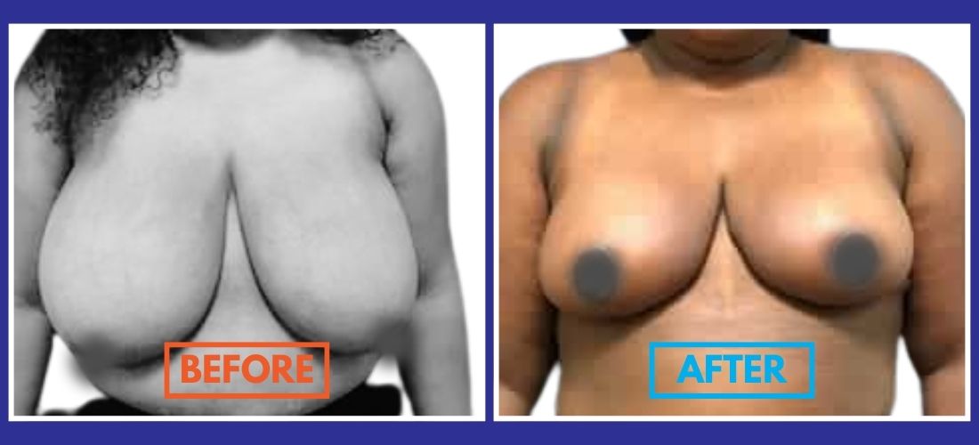 Side-by-side comparison of a woman's torso before and after a breast reduction surgery.