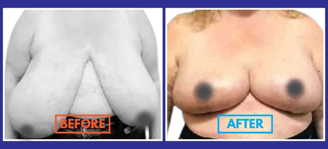 Before and after images showing breast reduction surgery results. Left: larger breasts with sagging. Right: smaller, lifted breasts.