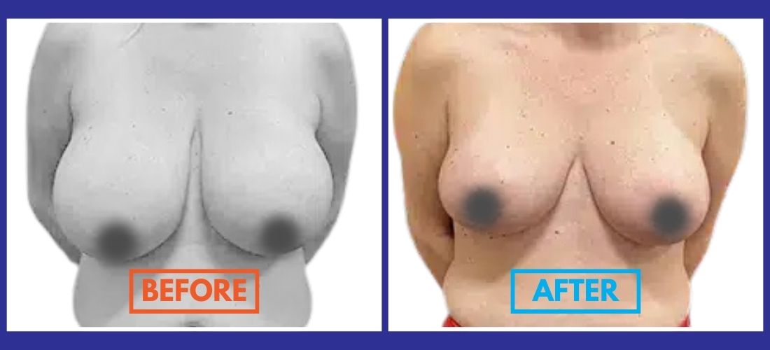 Side-by-side comparison of a woman's upper body before and after surgery, showing changes in breast size and shape.