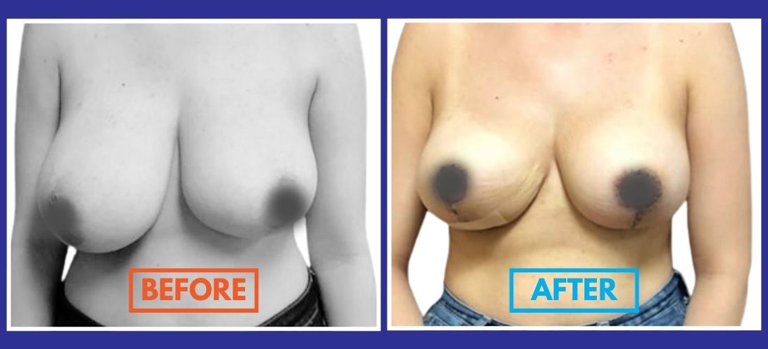 Side-by-side images showcase a woman's chest in a "Before & After" transformation following a cosmetic breast lift procedure. The left side is labeled "Before," and the right side is labeled "After.