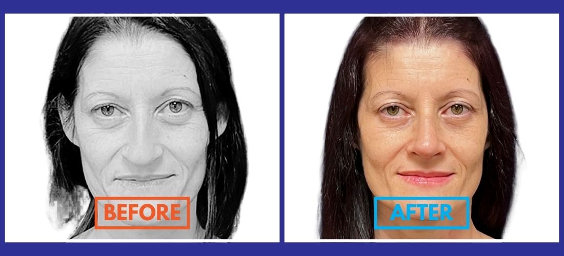 Side-by-side comparison of a woman's face, labeled "Before" on the left and "After" on the right, showing changes in skin tone and appearance.