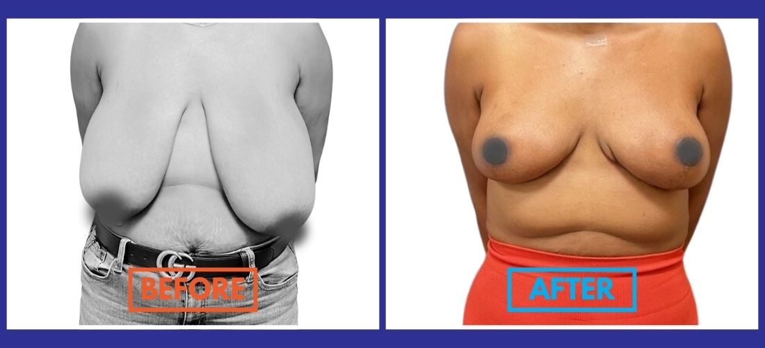 Side-by-side comparison of a person's torso, showing "Before" with sagging skin and "After" with firmer, lifted appearance, possibly post-surgery.