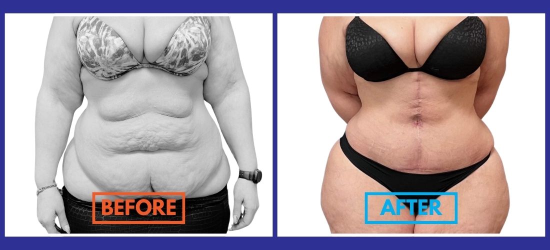 Side-by-side comparison of a woman, before and after body surgery. The left image shows loose skin, and the right image shows a smoother, contoured abdomen with a scar.