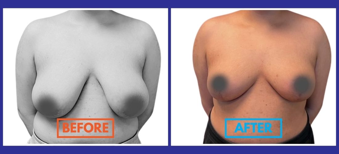 Side-by-side comparison of a woman before and after breast reduction surgery. The left image is in grayscale labeled "before"; the right image is in color labeled "after.