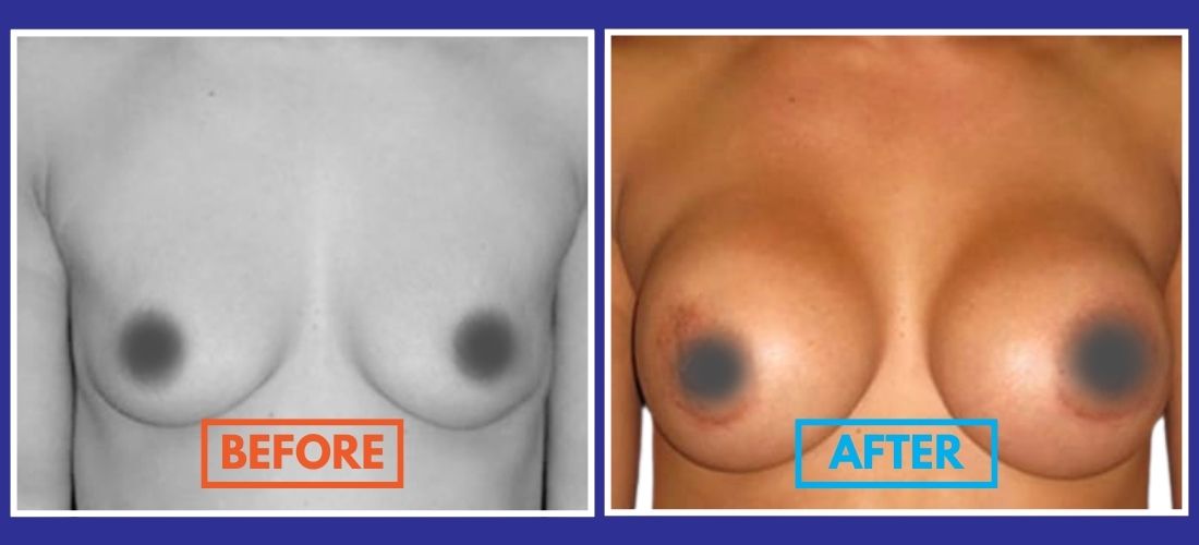 Side-by-side comparison of a person's chest before and after breast augmentation. The left image shows the chest pre-surgery, and the right image shows the chest post-surgery with increased size.