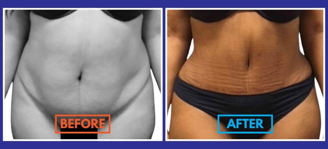 Side-by-side comparison of a person's midsection, labeled "Before" on the left and "After" on the right, showing a change in appearance.