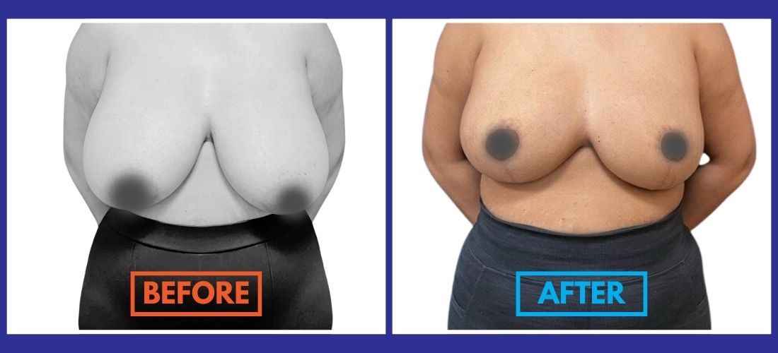 Side-by-side images show the same person before and after a surgical breast reduction. The "Before" image shows larger breasts, while the "After" image shows reduced breast size.